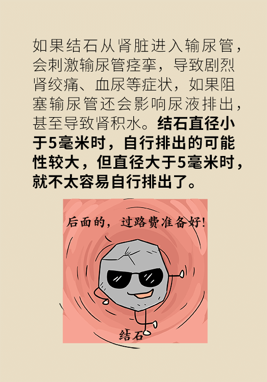 不喝白开水也生病？来看看不可小觑的尿路结石